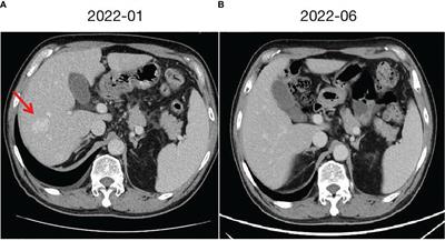 Hepatic cavernous hemangioma developed in non-small cell lung cancer patients after receiving Camrelizumab treatment: two case reports